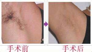 腋臭夏天的护理方法有什么呢