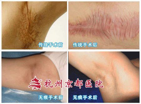 贵阳治疗狐臭哪家好