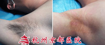 腋臭有哪些症状表现